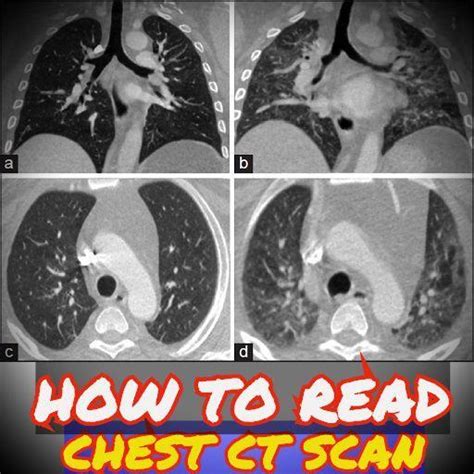Ct Chest Anatomy Anatomical Charts And Posters