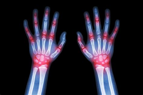 Trials For Early Onset Jia Treatment Show Promise Rheumatology Network