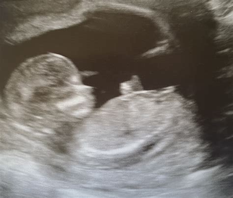 Early Gender Scan On Saturday Any Guesses Babycentre
