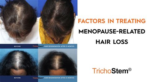 Treating Factors Of Menopause Hair Loss And Female Pattern Hair Loss