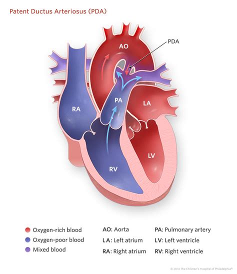 Patent Ductus Arteriosus Pda Childrens Hospital Of Philadelphia