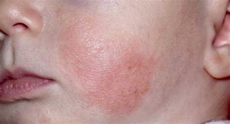 Baby Face Eczema Treatment