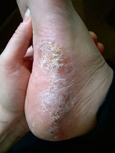 Blisters On Feet Can Be Due To Eczema Psoriasis Or Fungal Infections