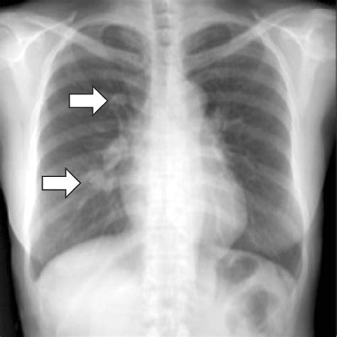 PDF Intrathoracic Desmoid Tumor Presenting As Multiple Lung Nodules