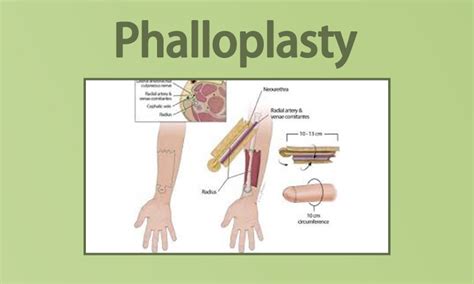 Phalloplasty Before And After