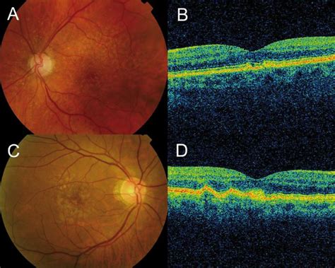 Optical Coherence Tomography In Age Related Macular Degeneration