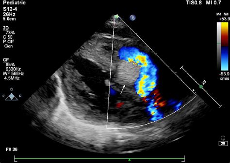 Twin 1 Two Dimensional Transthoracic Echocardiography Parasternal