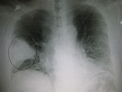 Normally a pa and lateral view are obtained. Pneumonia - Wikipedia
