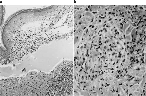 Figure 2 From A Case Of Anaphylactoid Purpura With Multiple Blister