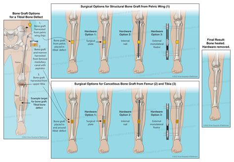 Bone Graft Surgery Leg Doctorvisit