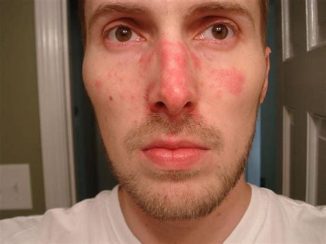 What Causes Rash On Face