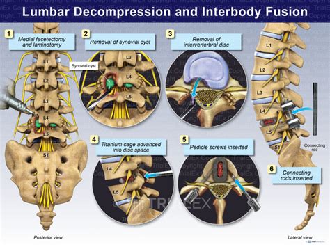 Lumbar Decompression And Interbody Fusion Trial Exhibits Inc