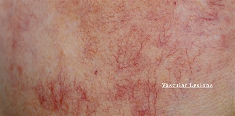 What Are Vascular Lesions