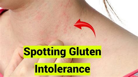 Spotting Gluten Intolerance 8 Signs You Shouldnt Ignore Youtube