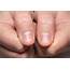 What Your Fingernail Lines Say About Health – World Wise News