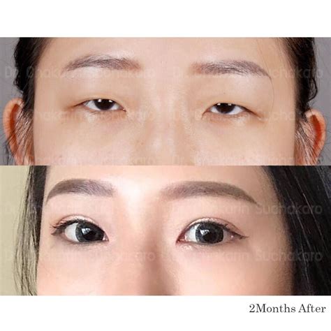 Before And After Photos Of Double Eyelid Procedure By Dr Chakarin