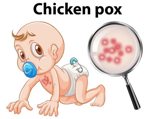 A Baby With Chicken Pox 297819 Vector Art At Vecteezy