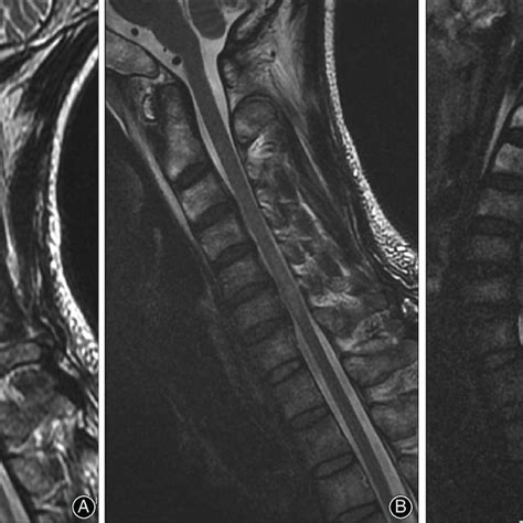 Cervical Kinematic Mri Of Spinal Cord Injury In A 44 Year Old Male