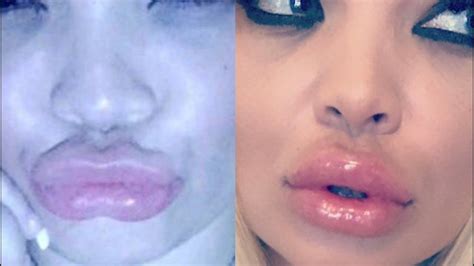 How I Fixed My Botched Lip Injections Dissolver Review Youtube