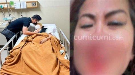 Pakar Medis Ragukan Foto Wajah Venna Melinda Berlumur Darah Di Kdrt Ferry Irawan Ungkap