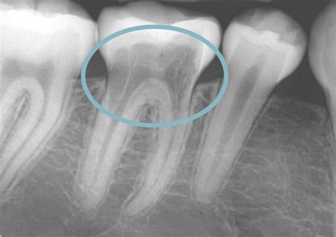 An Explanation Of Tooth Resorption Laurel Dental Clinic