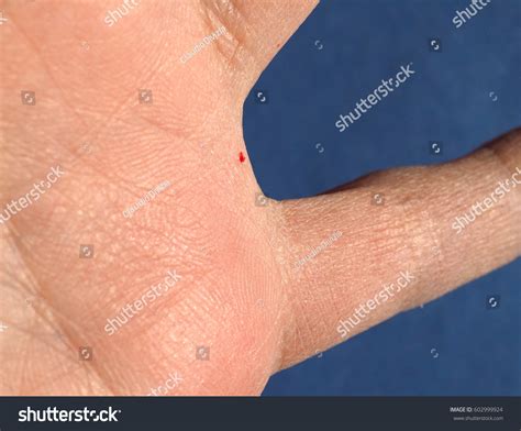 Minor Bruise Drop Blood On Hand Stock Photo 602999924 Shutterstock