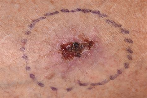 Squamous Cell Carcinoma Marked Before Skin Excision Surgery Stock