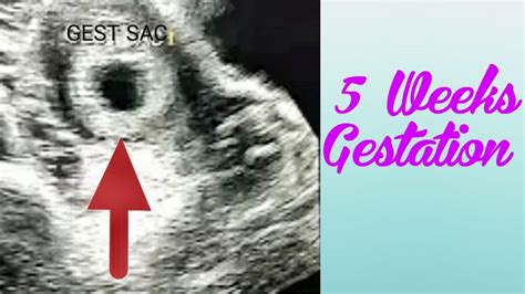 Ultrasound 5 Weeks Gestation Early Pregnancy Scan Gestational Sac
