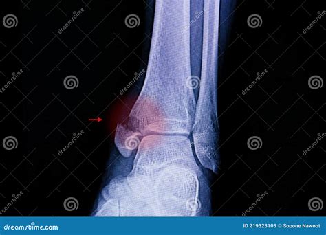 Ankle Radiographs Stock Photo 42420282