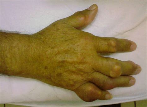 Multiarticular Chronic Tophaceous Gout With Severe And Multiple