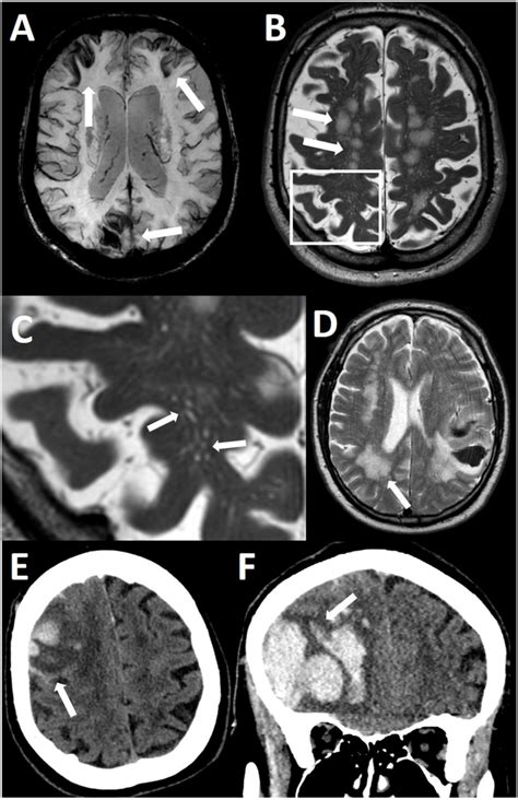 Frequency Of Deep Seated Cerebral Microbleeds In Patients With Lobar