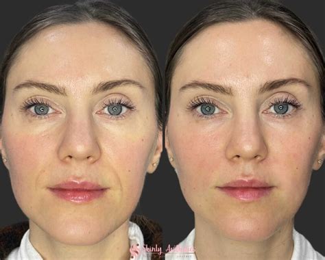 Smile Lift Treatment With Fillers Benefits Costs Results