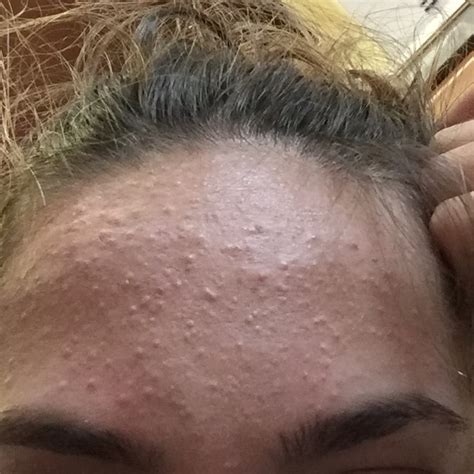 Hundreds Of Forehead Bumps I Cant Get Rue Of General Acne Discussion