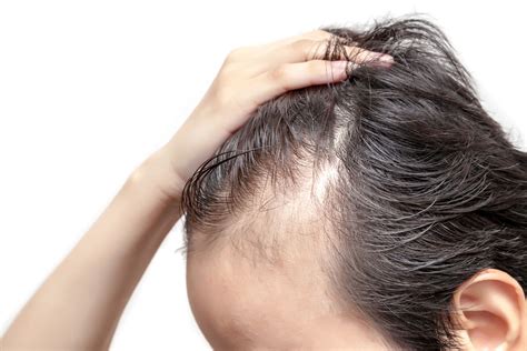 15 Best Solution For Receding Hairline