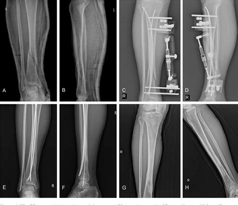 Figure 4 From Treatment Of Segmental Tibial Shaft Fractures