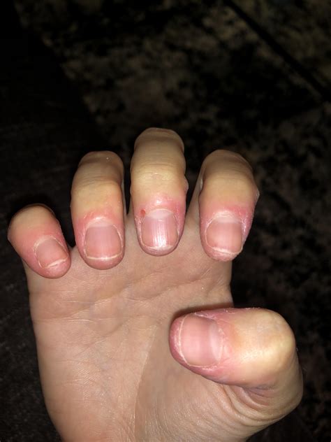 I Relapsed To Biting My Nails And The Skin Again My Biggest Problem Is