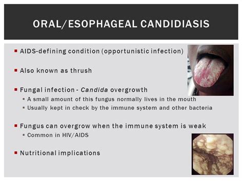 Esophageal Candidiasis And Dysphagia What Causes Yeastinfection SexiezPix Web Porn