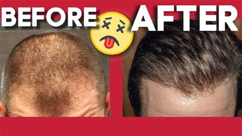 Incredible Fue Hair Transplant Months Results Before After Youtube