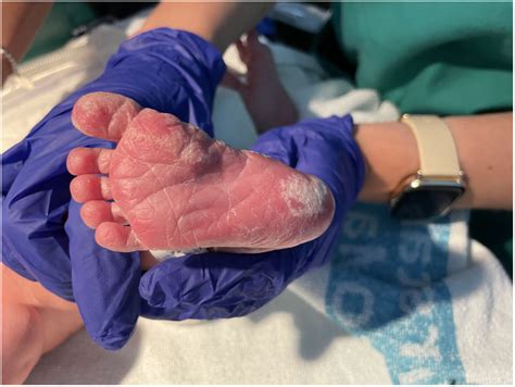 Linear Hyperkeratotic Papules In A Full Term Newborn Actas Dermo