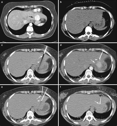 Liver Biopsy Radiology Key