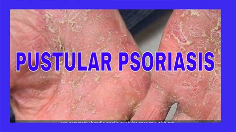 Pustular Psoriasis Symptoms Treatments Causes Pictures Type