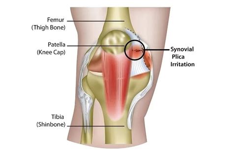 Why Do Your Knees Click And Should You Worry Complete Physio