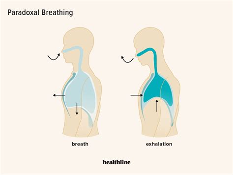 Paradoxical Breathing Symptoms Causes And Treatments