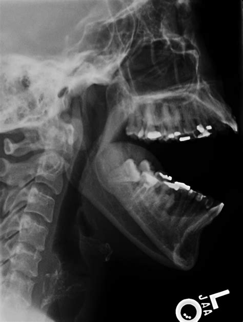 Temporomandibular Joint Dislocation Image