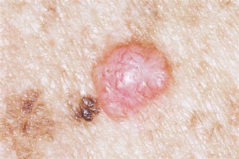 Skin Cancer On Face Precancerous Skin Lesions And Skin Cancer Pinterest