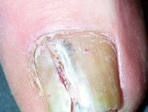 The diagnosis of melanoma is confirmed by biopsy of the nail matrix and nail bed. Melanoma of nail unit | DermNet NZ