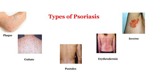 What Is Psoriasis 7 Types Of Psoriasis Pictures And Symptoms
