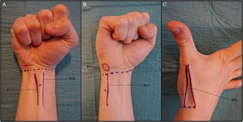 Peripheral Nerve Blocks At The Wrist A Median Nerve Block B Ulnar