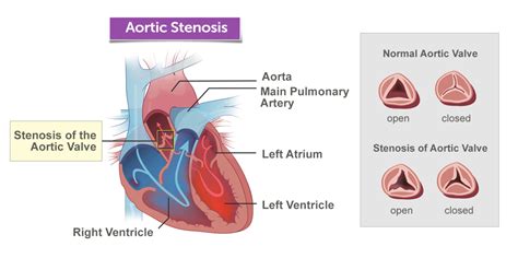 Aortic Stenosis Diagnosis And Available Treatments Robustposts