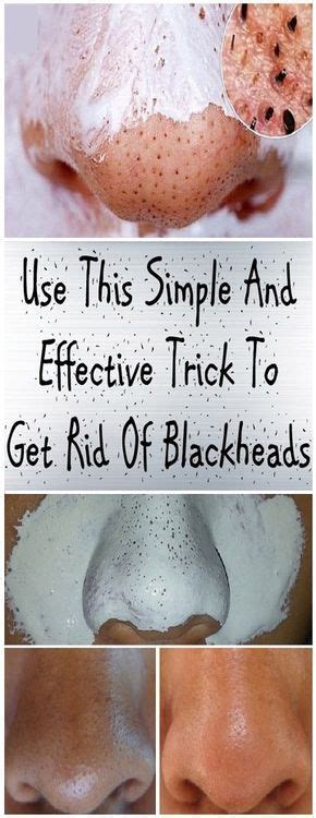 Use This Simple And Effective Trick To Get Rid Of Blackheads Health Roots